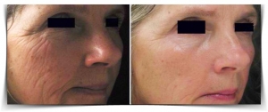 Micro Needling