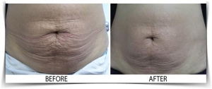 MicroNeedling04