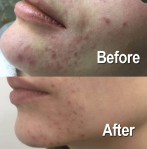 Skin Peel - ScarPro