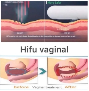 Hifu Vaginal