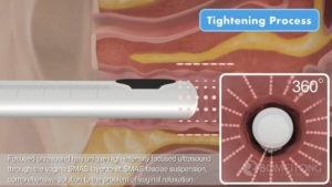 Vaginal Rejuvenation