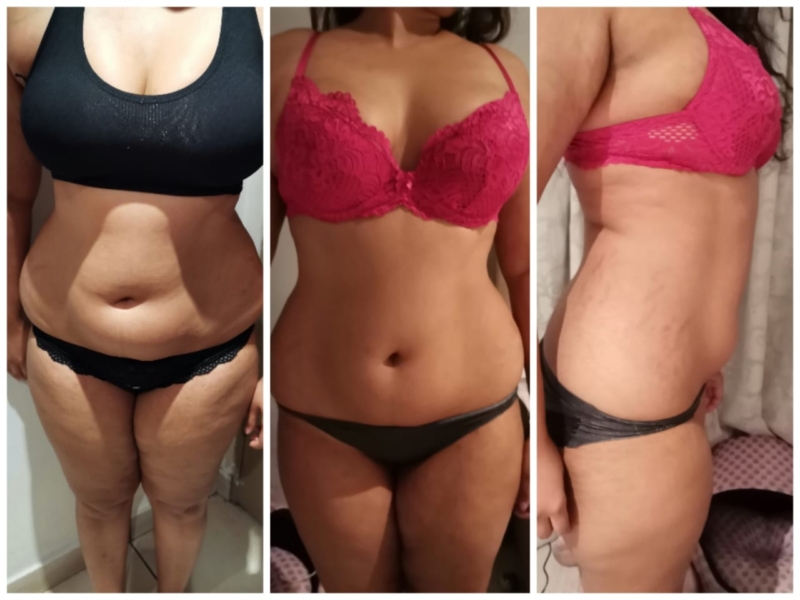 Lipo Laser Treatment