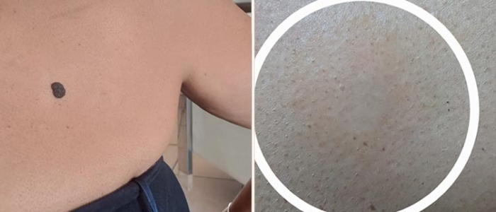 Mole Removal 02