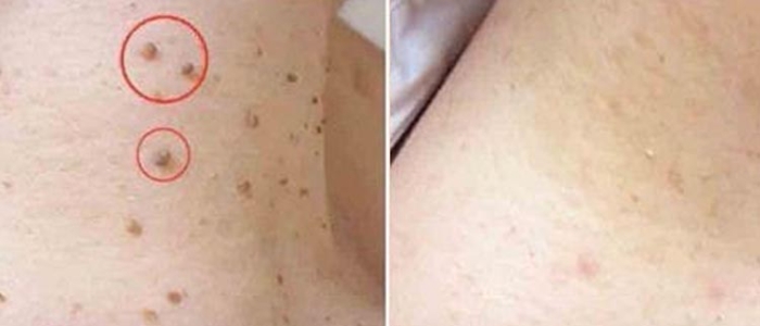 Mole Removal 03