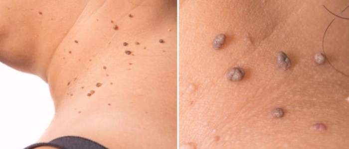 Mole Removal 04